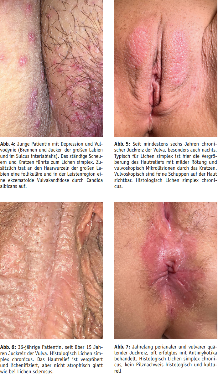 Lichen Simplex Chronicus Der Vulva Lichen Serie Teil 3 Prof Dr